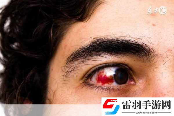 眼睛也会中风。