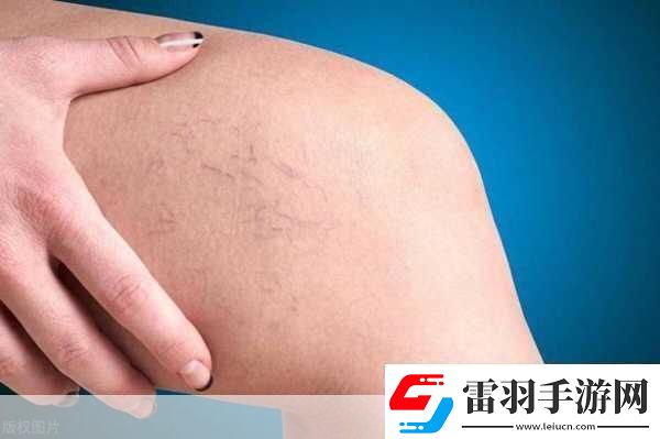 日系裸妆女士静脉曲张是什么得的