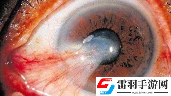 获得超级胬肉系