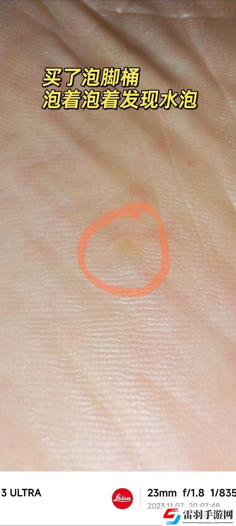 脚底长了像水泡一样的东西很痒该怎么办如何解决
